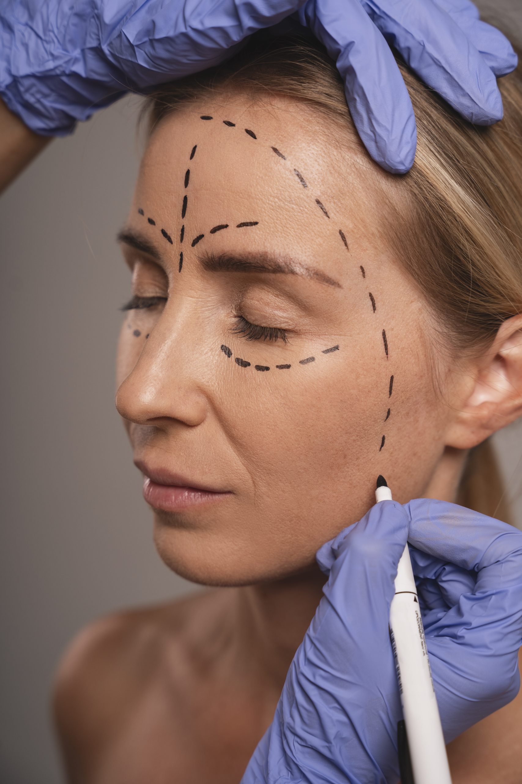 Lifting Facial-10 Sessões